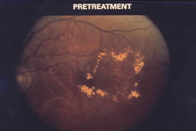 Macular Edema Macular Edema (Diabetic Retinopathy)